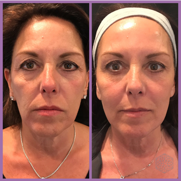 HarmonyBeauty - Faceliftapparaat Huidverjongingsapparaat | Lift En Verstevig Je Huid!