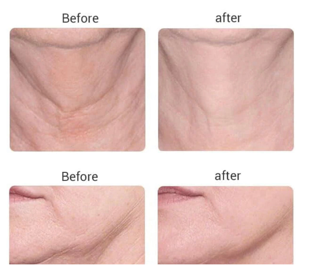 HarmonyBeauty - Faceliftapparaat Huidverjongingsapparaat | Lift En Verstevig Je Huid!